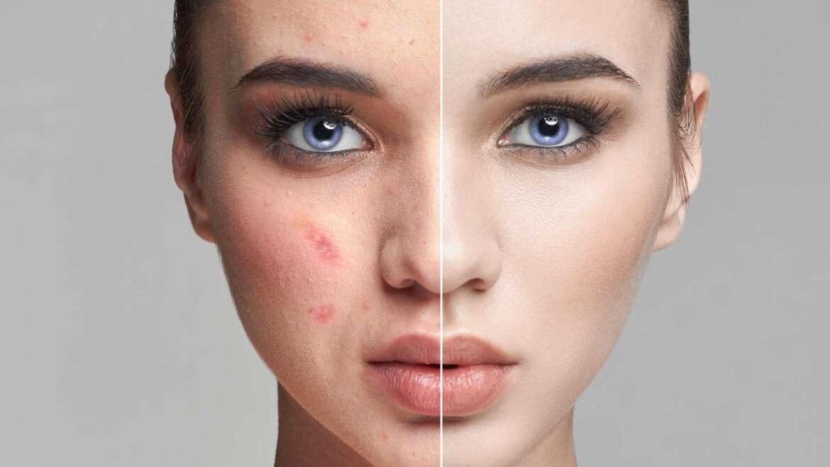 Skin boosters